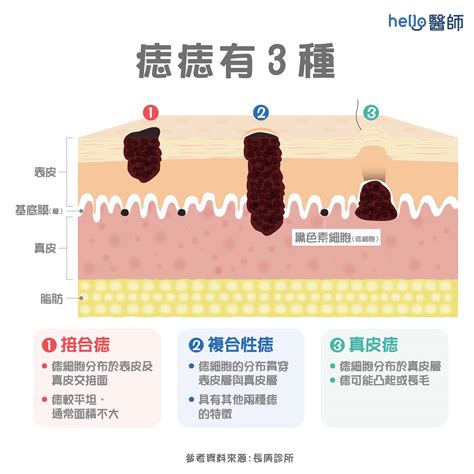 痣 凸起來|痣變大、痣多或長毛會變皮膚癌？認識痣的形成與原因